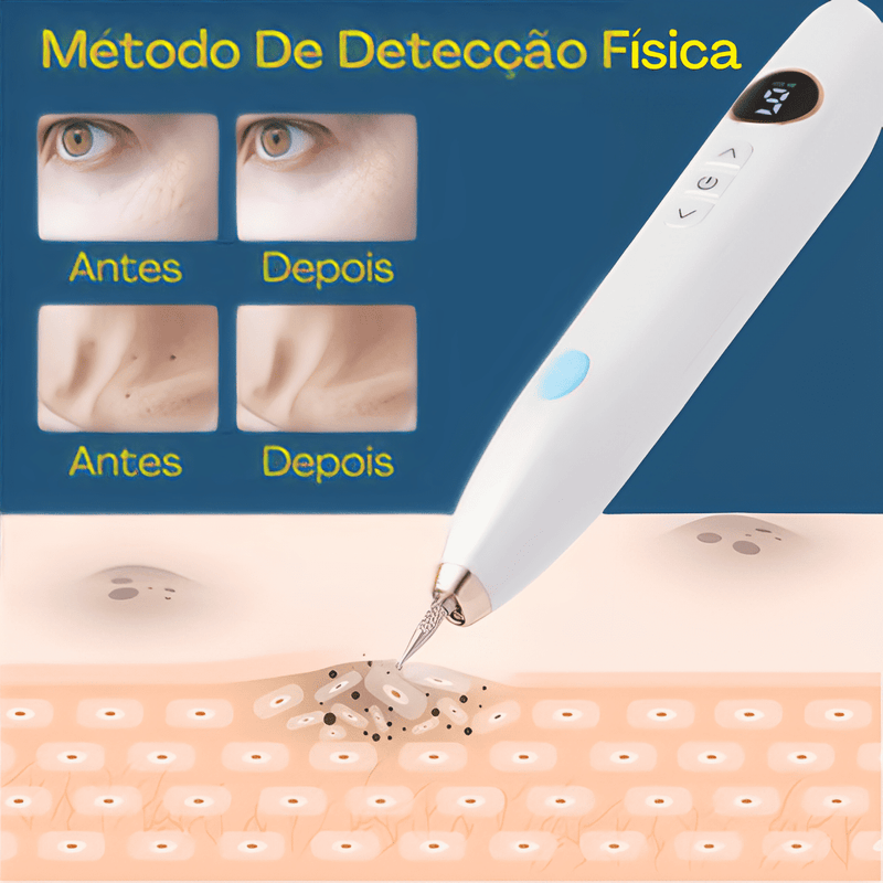 RenovaSkin - Removedor De Marcas De Pele, Cravos, Verrugas ect - Laser Elétrico - Kit Cauterizador