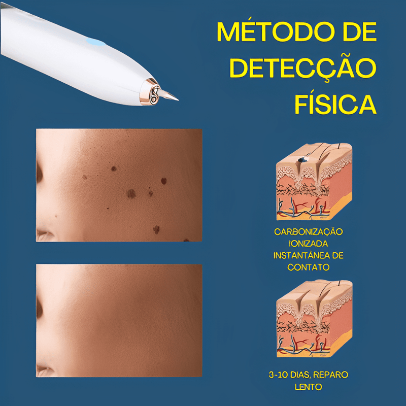 RenovaSkin - Removedor De Marcas De Pele, Cravos, Verrugas ect - Laser Elétrico - Kit Cauterizador